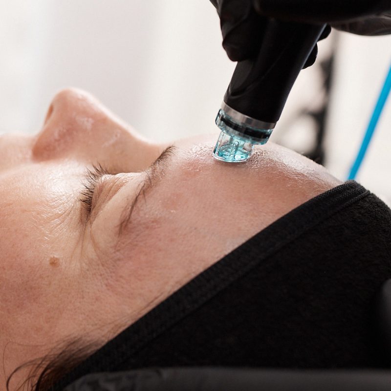 Hydrafacial Treatment Image_ Extraction